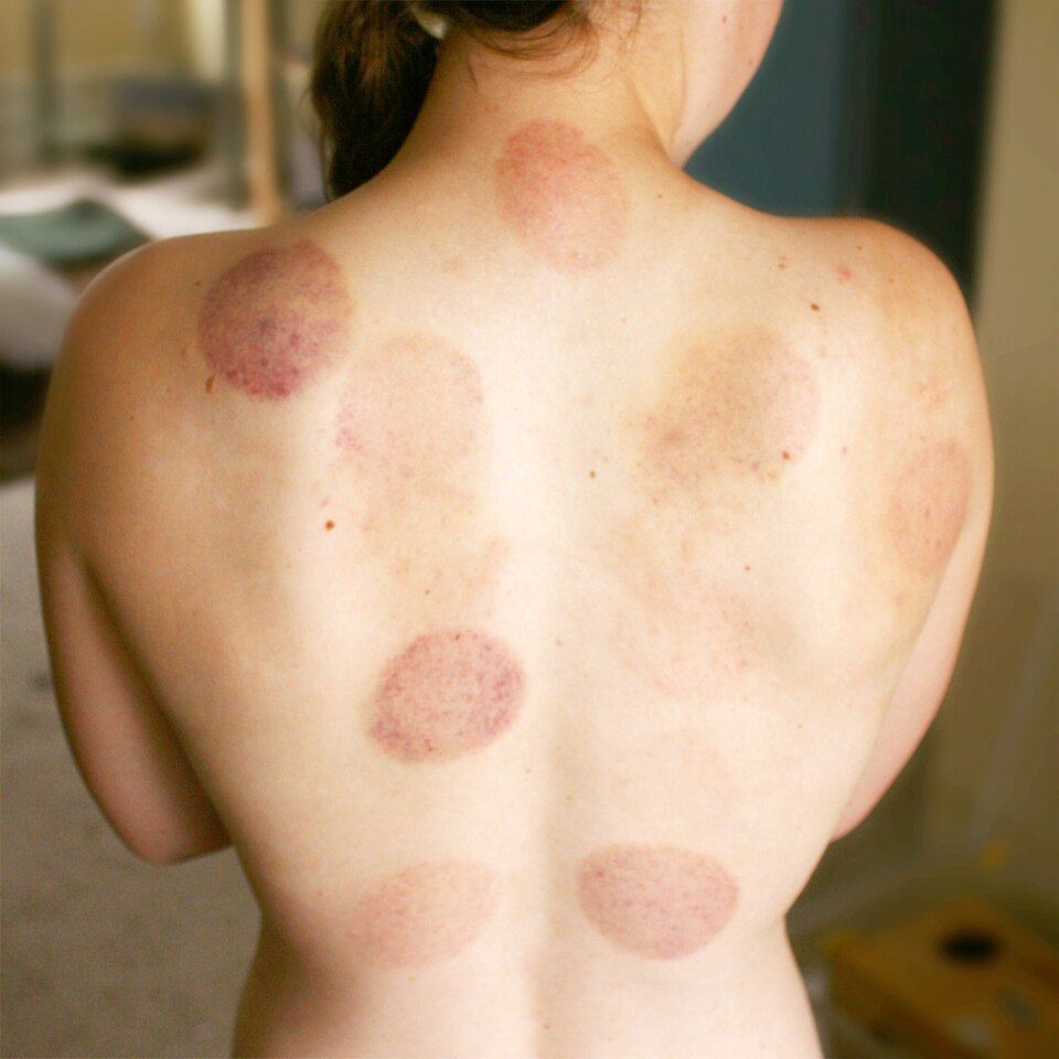 Bruising marks on a person's back from fire cupping therapy, the circular marks characteristic of the traditional Chinese medicine treatment